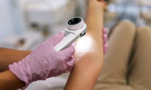 Raios UV causam 80% dos melanomas no mundo, segundo agência da OMS