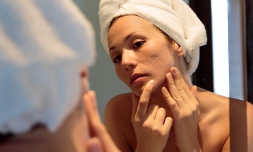 Mudança de comportamento do consumidor faz indústria avançar no cuidado da acne